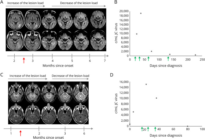 Allogeneic BK Virus-Specific T-Cell Treatment in 2 Patients With Progressive Multifocal Leukoencephalopathy.