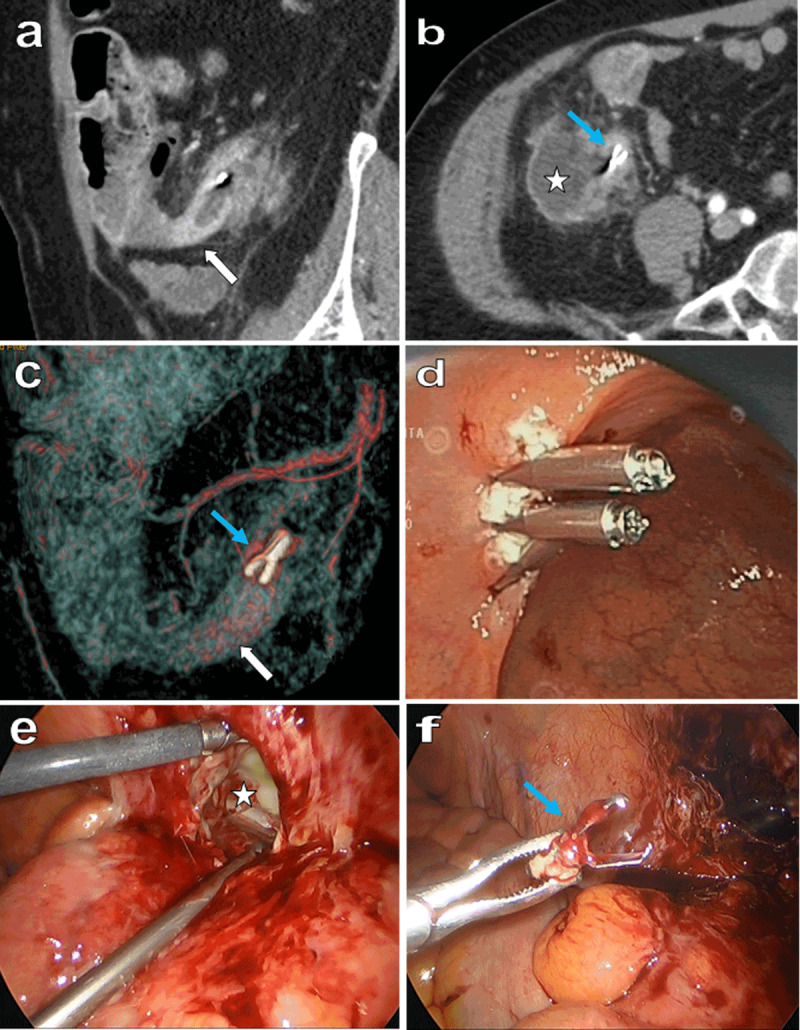 Colonic Hemostatic Clip Causing Perforated Acute Appendicitis.