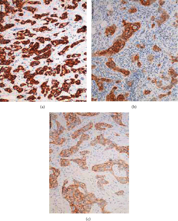 HER2 Testing Characteristics Can Predict Residual Cancer Burden following Neoadjuvant Chemotherapy in HER2-Positive Breast Cancer.