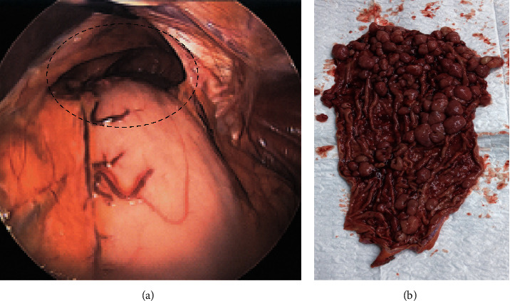 Longitudinal Gastrectomy for Nonbariatric Indications.