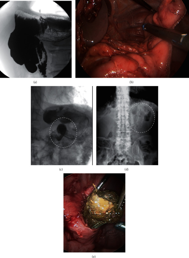 Longitudinal Gastrectomy for Nonbariatric Indications.