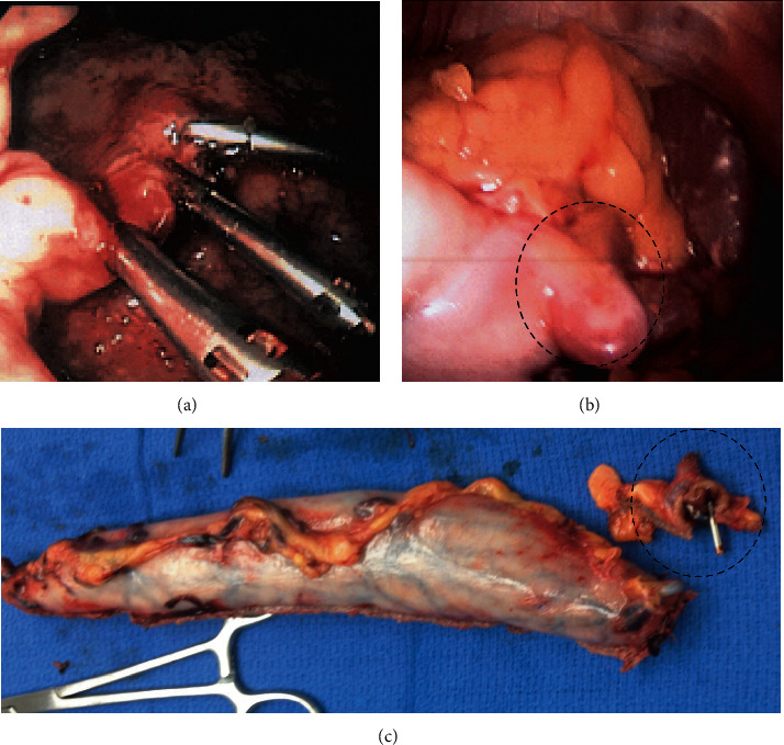 Longitudinal Gastrectomy for Nonbariatric Indications.