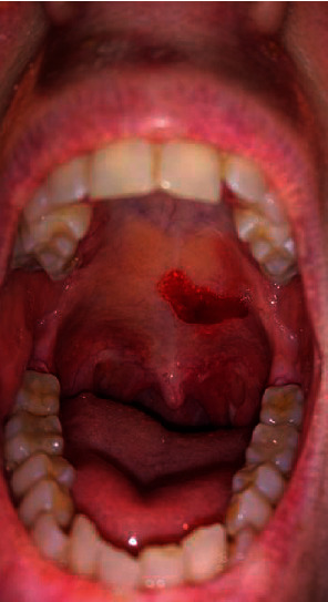 A Case of Severe and Refractory Membranous Nephropathy Associated to Mucous Membrane Pemphigoid.