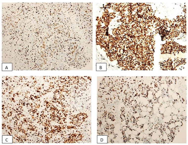 KI-67 LI Expression in Triple-Negative Breast Cancer Patients and Its Significance.