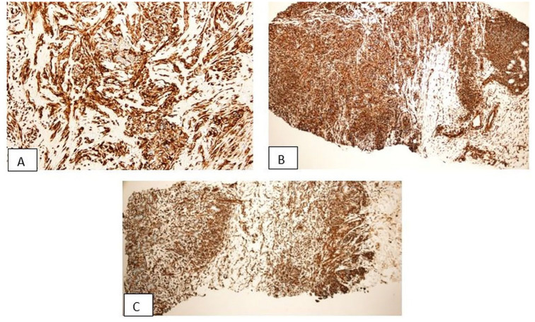 KI-67 LI Expression in Triple-Negative Breast Cancer Patients and Its Significance.