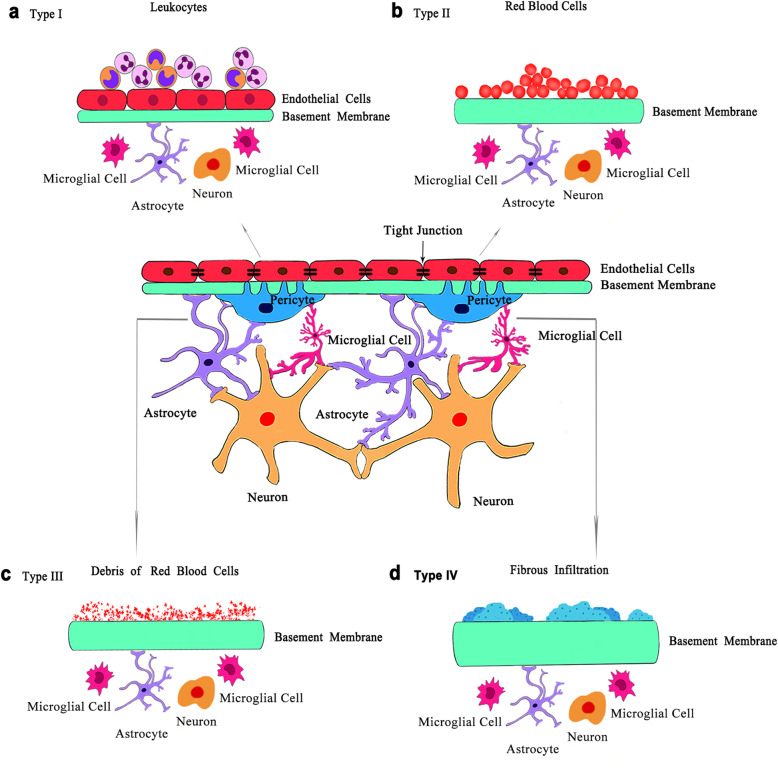 Neurovascular unit in diabetic retinopathy: pathophysiological roles and potential therapeutical targets.
