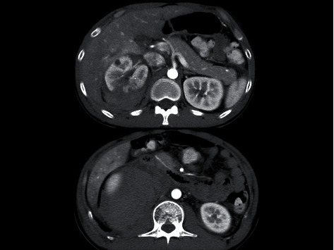 Posttraumatic Pancreatitis Four Days after Renal Injury with Massive Retroperitoneal Hematoma.