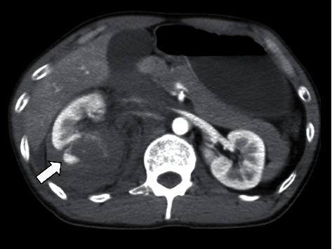 Posttraumatic Pancreatitis Four Days after Renal Injury with Massive Retroperitoneal Hematoma.