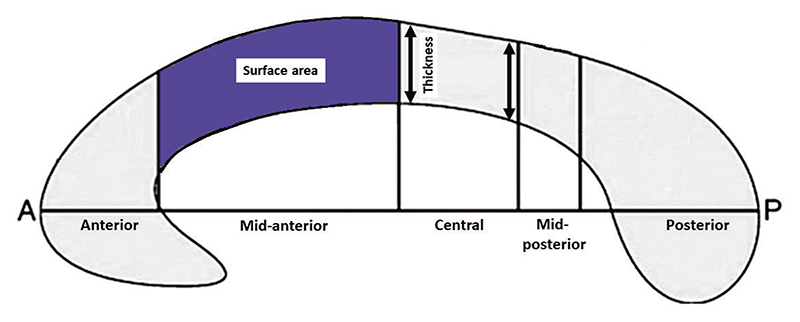 Morphometric mapping of the macrostructural abnormalities of midsagittal corpus callosum in Wilson's disease.