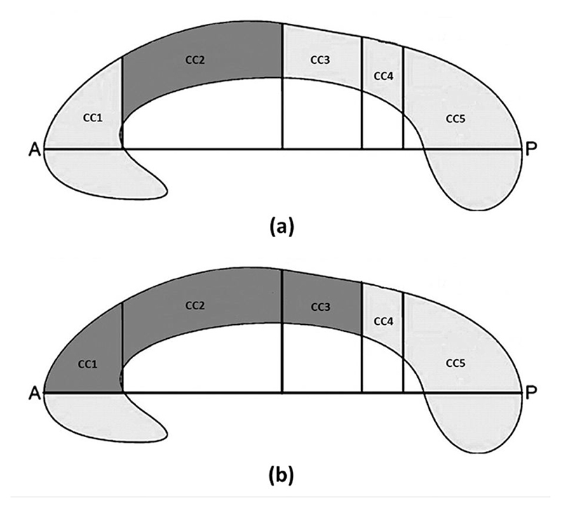 Morphometric mapping of the macrostructural abnormalities of midsagittal corpus callosum in Wilson's disease.