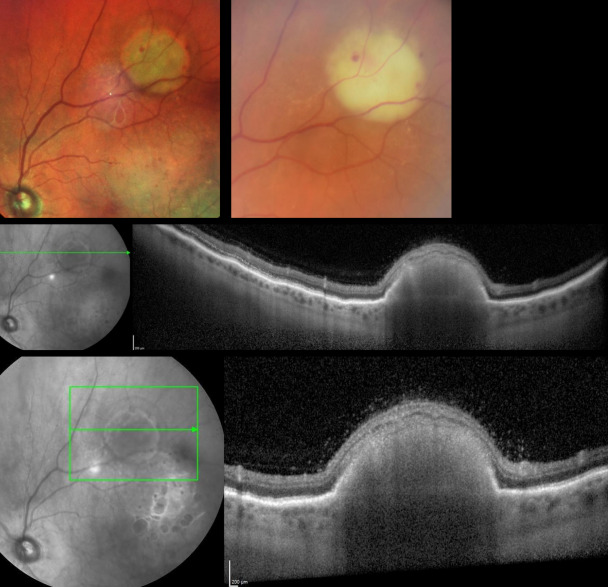 Endogenous ocular nocardiosis.