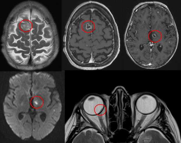 Endogenous ocular nocardiosis.