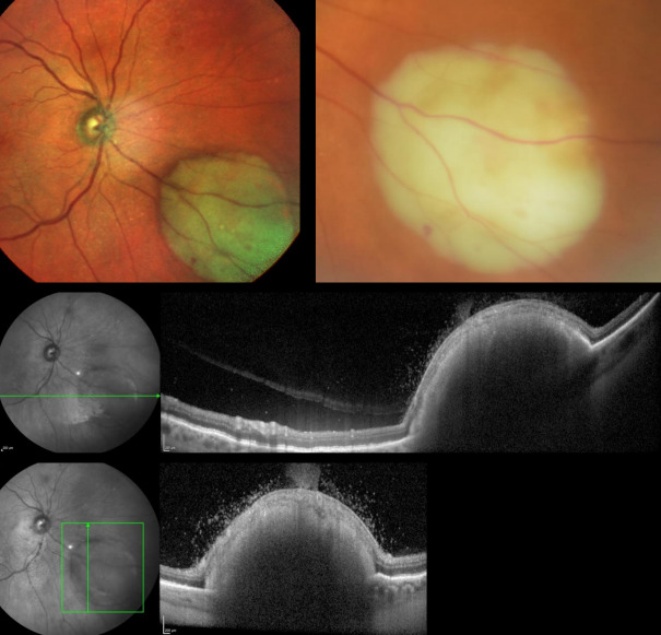 Endogenous ocular nocardiosis.