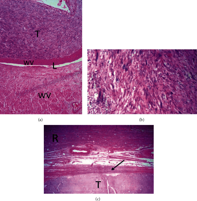 Leiomyosarcoma of the Renal Vein Mimicking a Primitive Renal Cell Carcinoma: Case Report of an Unusual Presentation.