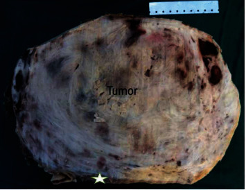 Leiomyosarcoma of the Renal Vein Mimicking a Primitive Renal Cell Carcinoma: Case Report of an Unusual Presentation.