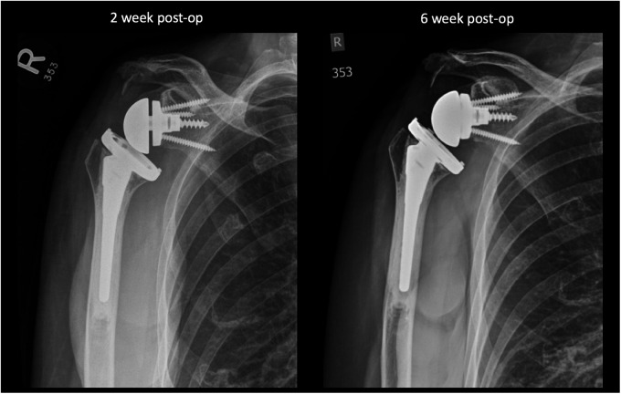 Scapular Notching Following Ipsilateral Traumatic Clavicle Fracture in Reverse Total Shoulder Arthroplasty: A Case Report.