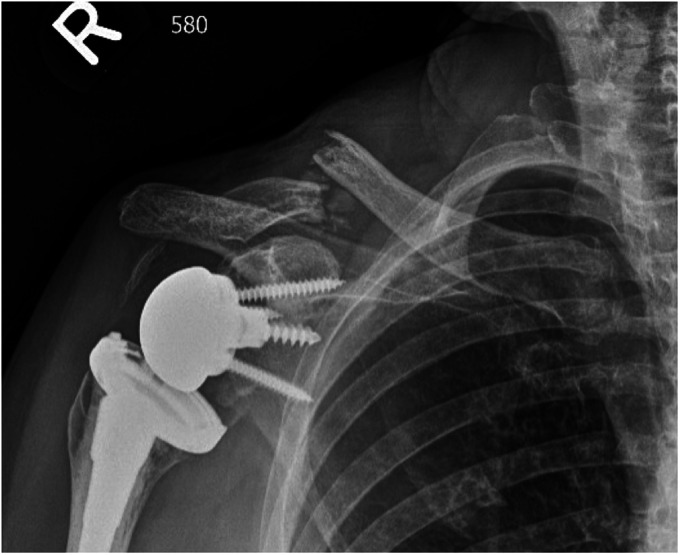 Scapular Notching Following Ipsilateral Traumatic Clavicle Fracture in Reverse Total Shoulder Arthroplasty: A Case Report.