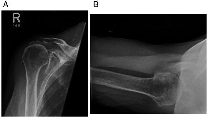 Scapular Notching Following Ipsilateral Traumatic Clavicle Fracture in Reverse Total Shoulder Arthroplasty: A Case Report.