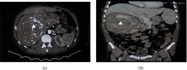 Leiomyosarcoma of the Renal Vein Mimicking a Primitive Renal Cell Carcinoma: Case Report of an Unusual Presentation.