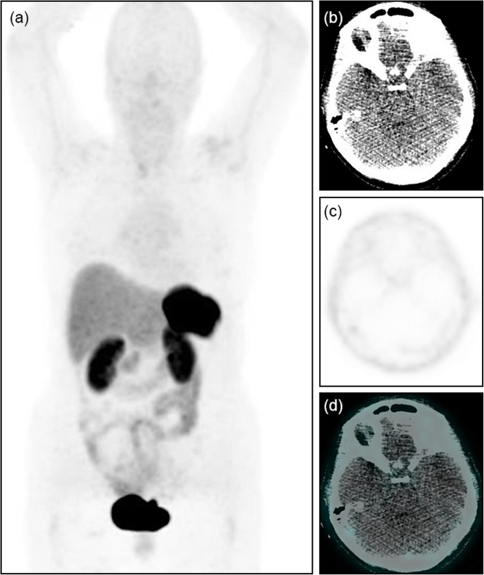 The value of [68Ga]Ga-DOTA-TATE PET/CT in diagnosis and management of suspected pituitary tumors.