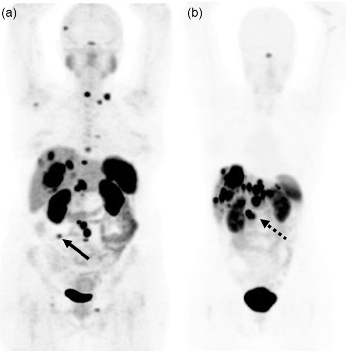 The value of [68Ga]Ga-DOTA-TATE PET/CT in diagnosis and management of suspected pituitary tumors.