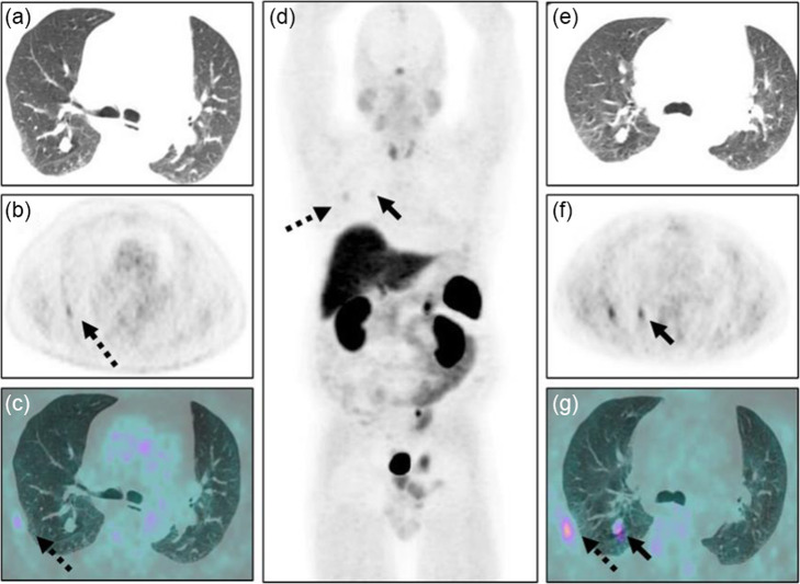 The value of [68Ga]Ga-DOTA-TATE PET/CT in diagnosis and management of suspected pituitary tumors.