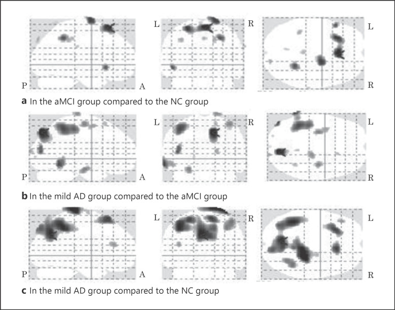 Characteristics of Regional Cerebral Blood Flow in Alzheimer Disease and Amnestic Mild Cognitive Impairment by Single-Photon Emission Computerized Tomography: A Cross-Sectional Study.