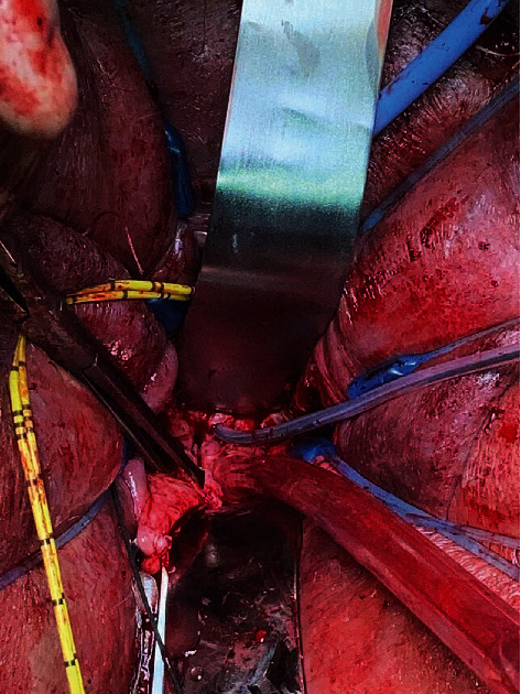 Utilizing Colpocleisis to Repair a Vesicovaginal Fistula in a Cervical Cancer Patient with History of Pelvic Radiation: A Case Report and Literature Review.