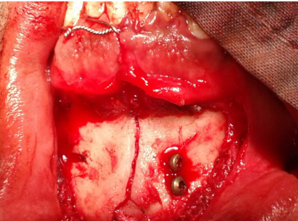 Comparison of lag screws and double Y-shaped miniplates in the fixation of anterior mandibular fractures.