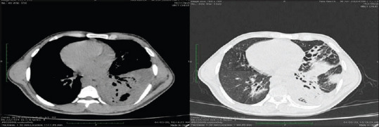 A case of Kartagener's syndrome with combined aplasia of frontal and sphenoid sinuses and hypoplasia of maxillary and ethmoid sinuses.