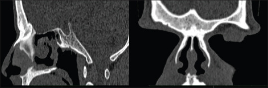 A case of Kartagener's syndrome with combined aplasia of frontal and sphenoid sinuses and hypoplasia of maxillary and ethmoid sinuses.