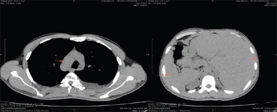 A case of Kartagener's syndrome with combined aplasia of frontal and sphenoid sinuses and hypoplasia of maxillary and ethmoid sinuses.