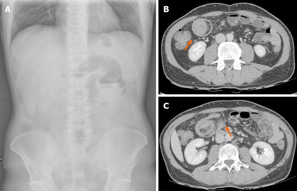 Bowel intussusception in adult: Prevalence, diagnostic tools and therapy.