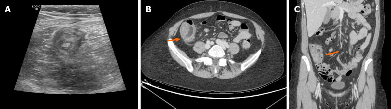 Bowel intussusception in adult: Prevalence, diagnostic tools and therapy.