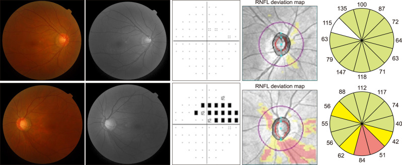 Clinical Evaluation of Unilateral Open-Angle Glaucoma: A Two-Year Follow-Up Study.