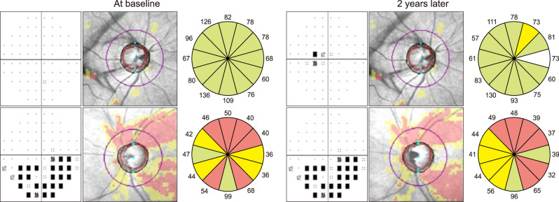 Clinical Evaluation of Unilateral Open-Angle Glaucoma: A Two-Year Follow-Up Study.