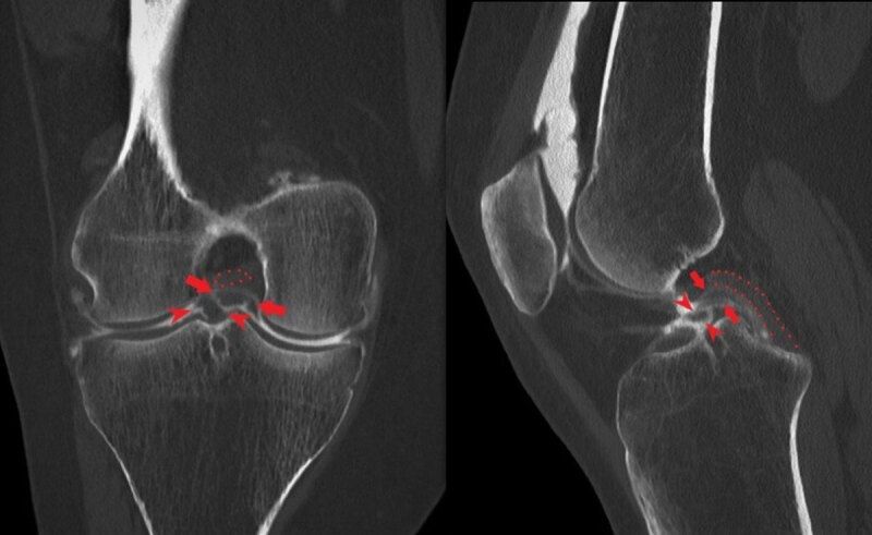 The Triple Posterior Cruciate Ligament Sign in Bicompartmental Bucket Handle Meniscal Tear.