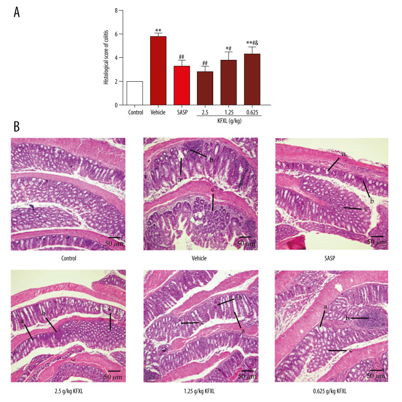 Kangfuxin Liquid Ameliorates Dextran Sulfate Sodium (DSS)-Induced Acute Ulcerative Colitis in Mice by Modulating Immune Response and Suppressing Inflammation.
