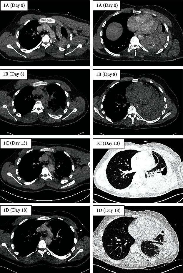 Use of Intrapleural Fibrinolytic Therapy in a Trapped Lung following Acute Traumatic Haemothorax.