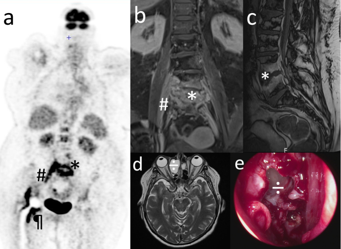 A rare case of invasive non-typeable <i>Haemophilus influenzae</i> spondylodiscitis and periprosthetic joint infection.