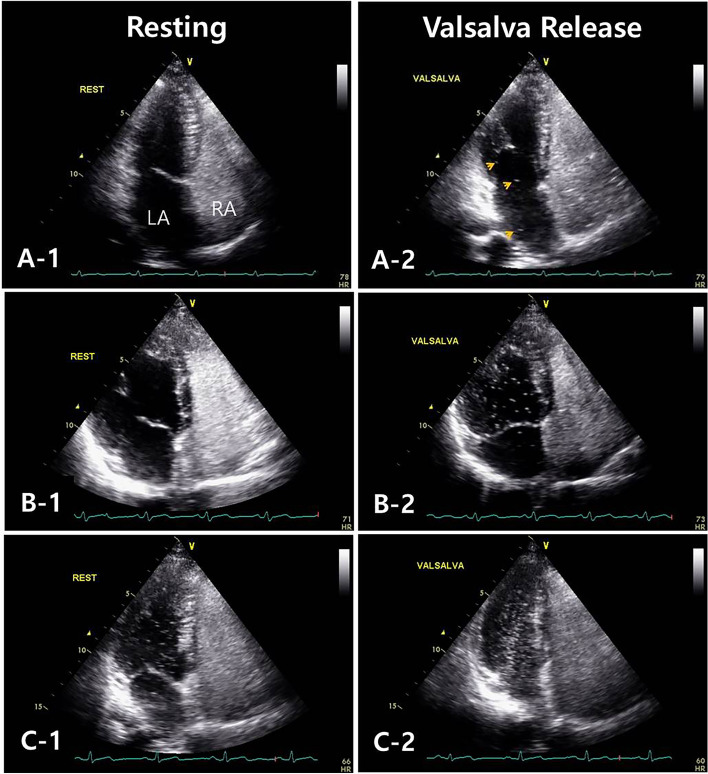 Characteristics and prognosis of patients with cryptogenic stroke and suggestive of patent foramen ovale.