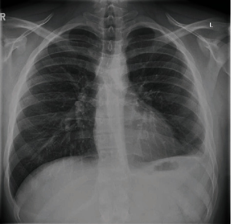 Use of Intrapleural Fibrinolytic Therapy in a Trapped Lung following Acute Traumatic Haemothorax.