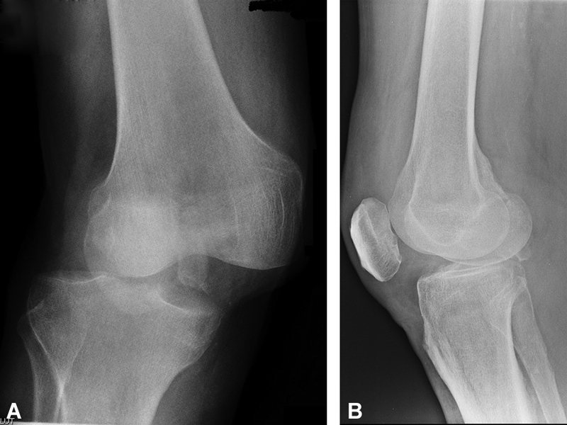 Irreducible Posterolateral Fracture Dislocation of the Knee in an Elderly Patient Treated with Rotating Hinge Total Knee Replacement.