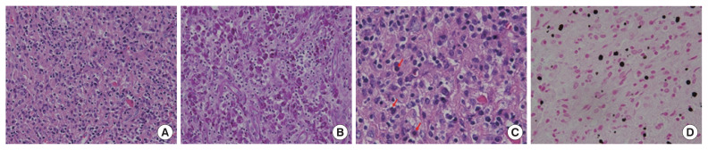 Cecal malakoplakia: A case report.