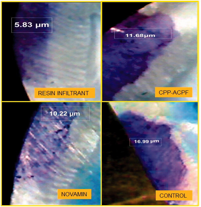 A comparative evaluation of penetration depth and surface microhardness of Resin Infiltrant, CPP-ACPF and Novamin on enamel demineralization after banding: an <i>in vitro</i> study.