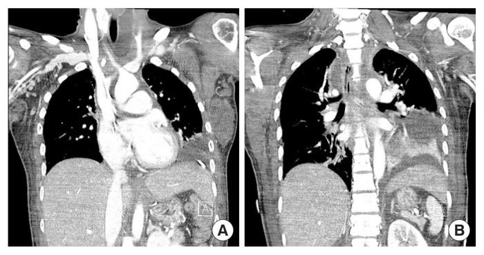 Rare case of postoperative mediastinitis following thyroidectomy.