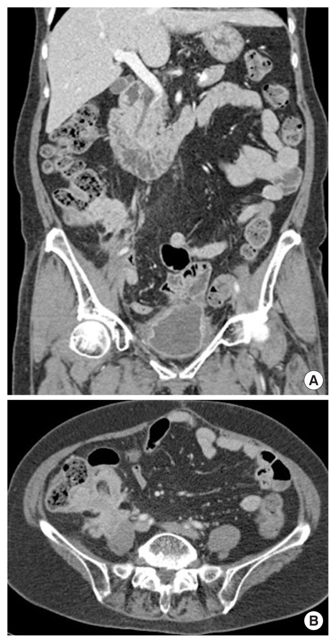 Cecal malakoplakia: A case report.