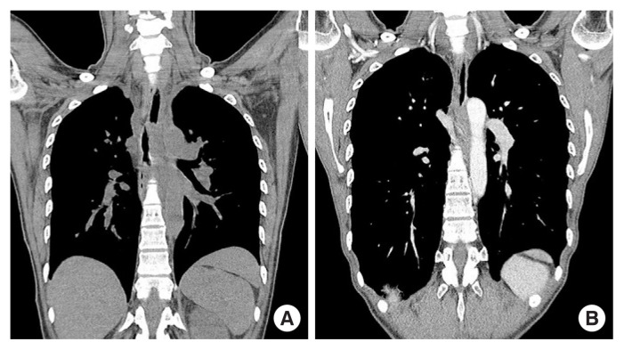 Rare case of postoperative mediastinitis following thyroidectomy.