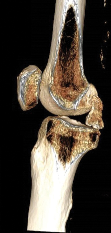 Irreducible Posterolateral Fracture Dislocation of the Knee in an Elderly Patient Treated with Rotating Hinge Total Knee Replacement.