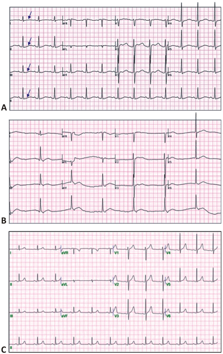 Confirming Genetic Abnormalities of Hypokalemic Periodic Paralysis Using Next-Generation Sequencing: A Case Report and Literature Review.